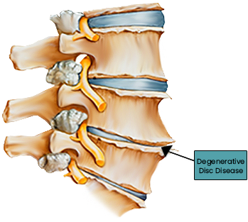 Degenerative-disc-disease