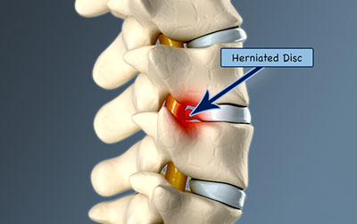 Herniated-Disc