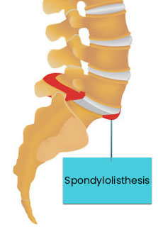 Spondylolisthesis