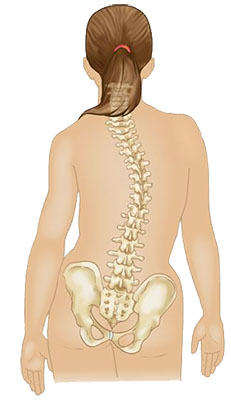 scoliosis